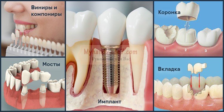Какие виды лечения входят в протезирование зубов?