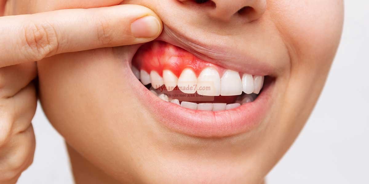 Абсцесс зуба: симптомы и методы лечения