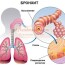 Лечение бронхита в домашних условиях
